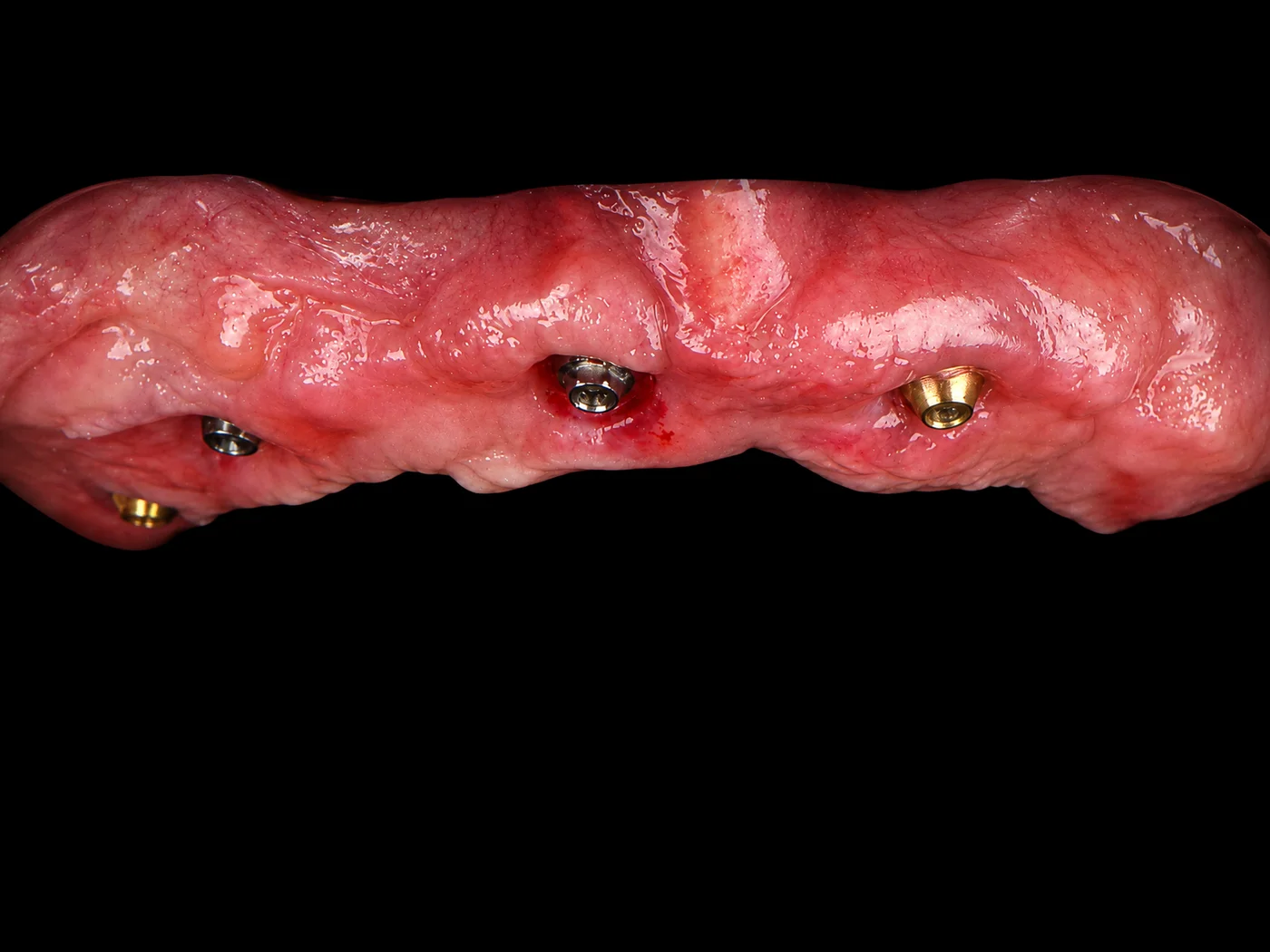 All-on-4 implant tedavisi hasta örneği 04, önce