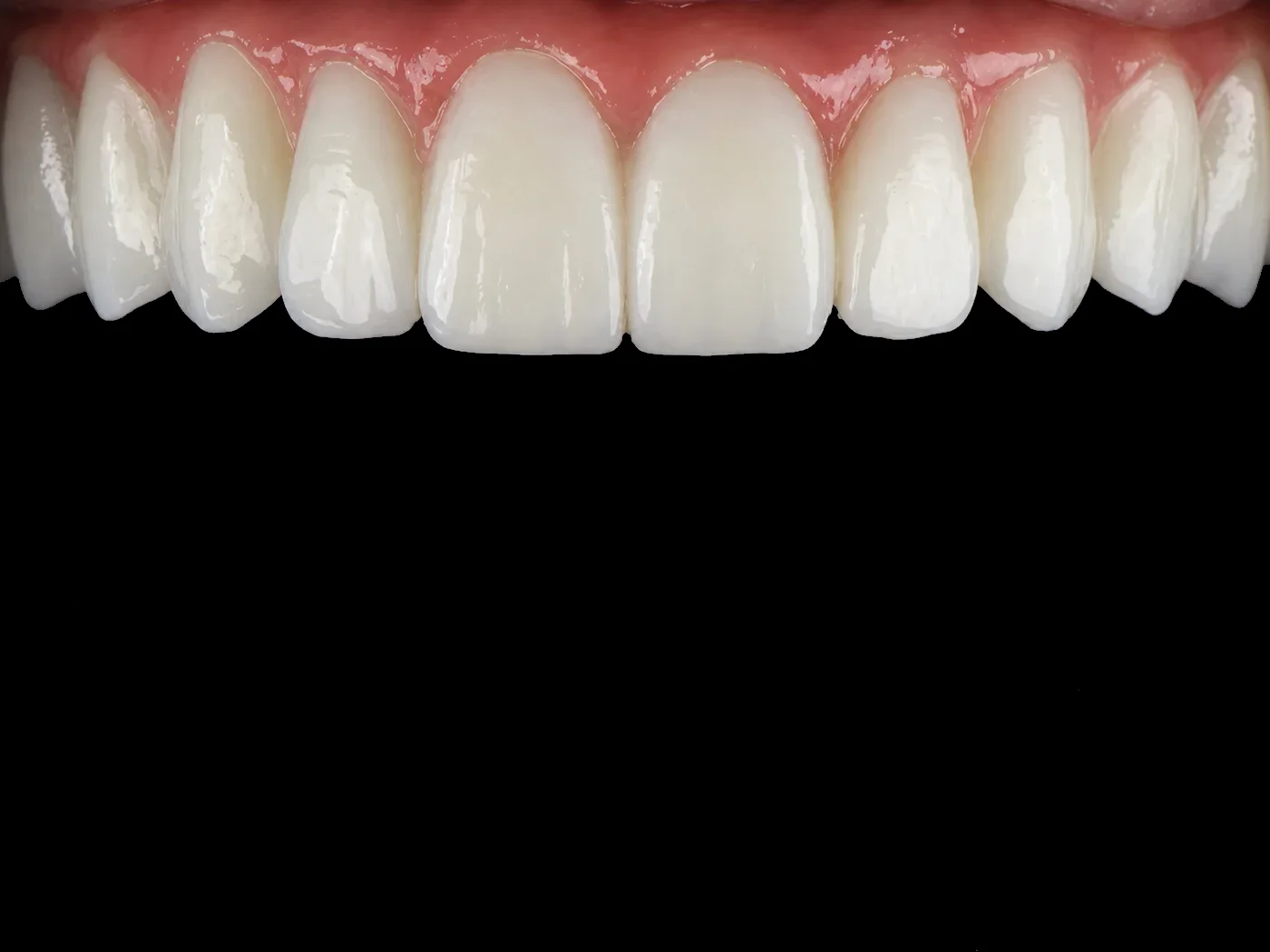 All-on-4 implant tedavisi hasta örneği 04, sonra