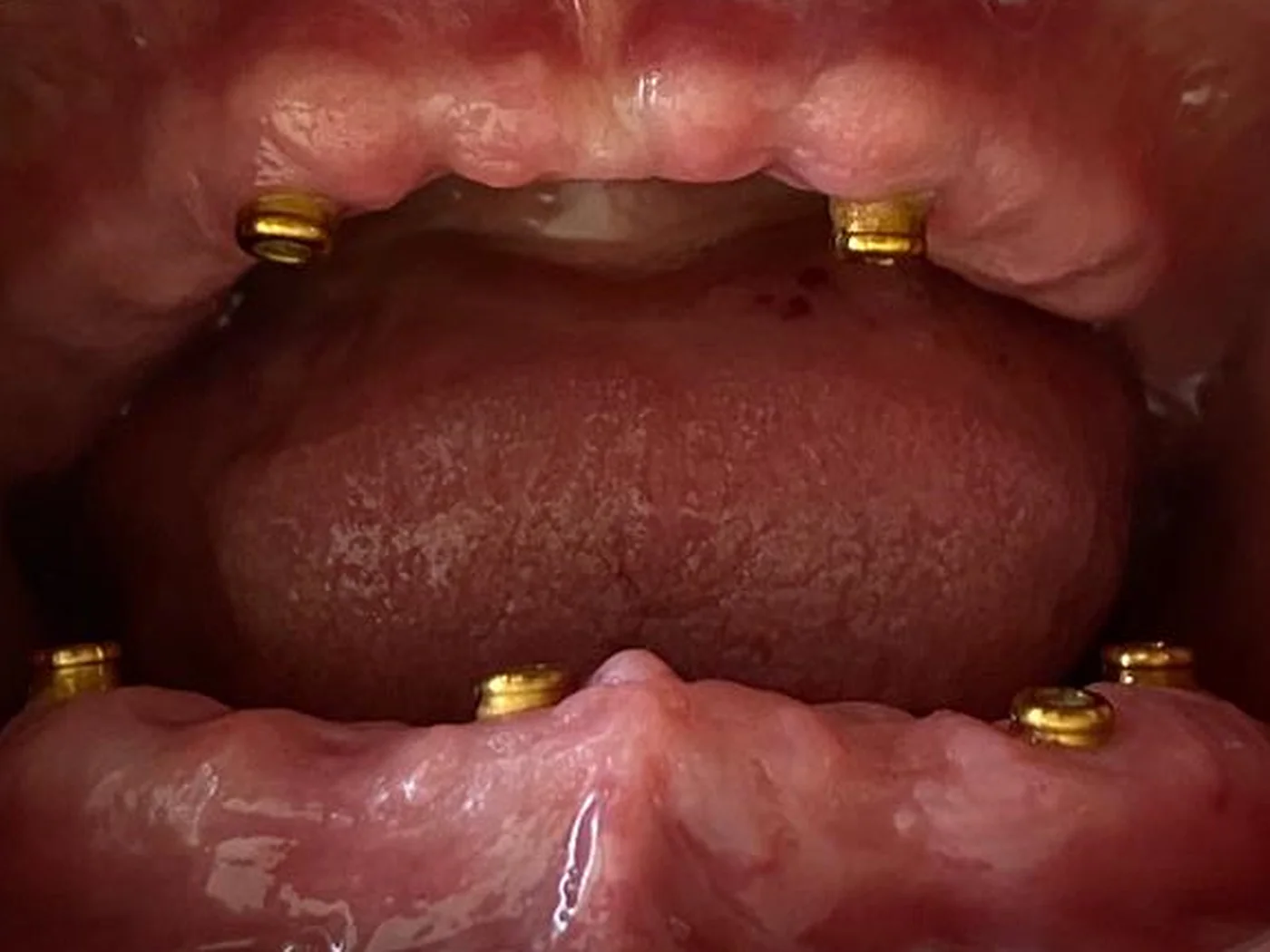 Protez altı implant hasta örneği 01, önce